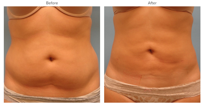 Image result for liposuction