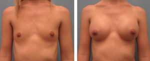 Woman with a flat chest and her chest after she had breast implants, Baton Rouge LA