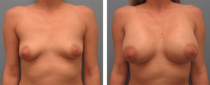 Woman with small breasts and a woman with big breasts, Breast Augmentation, Baton Rouge LA