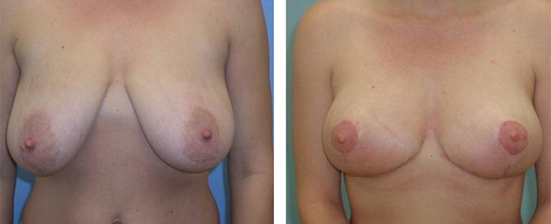Before and After photo of Breast Lift Surgery