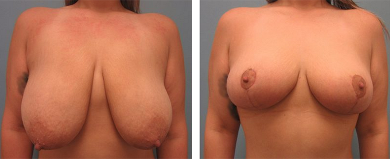 Before and After photo of Breast Lift Surgery