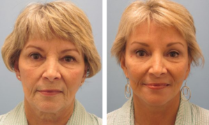 woman with loose facial skin and woman with less visible loose skin, Facelift, Baton Rouge LA