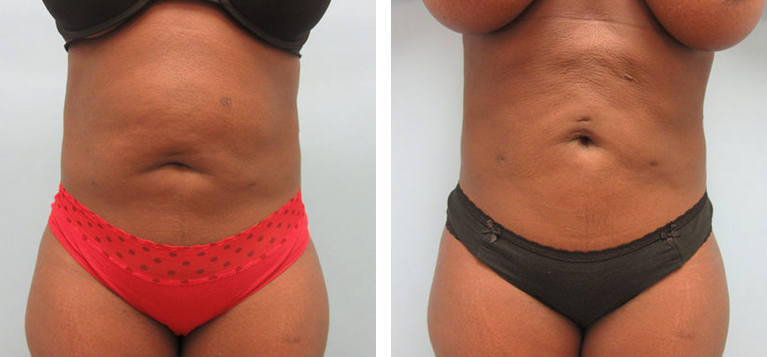 Liposuction