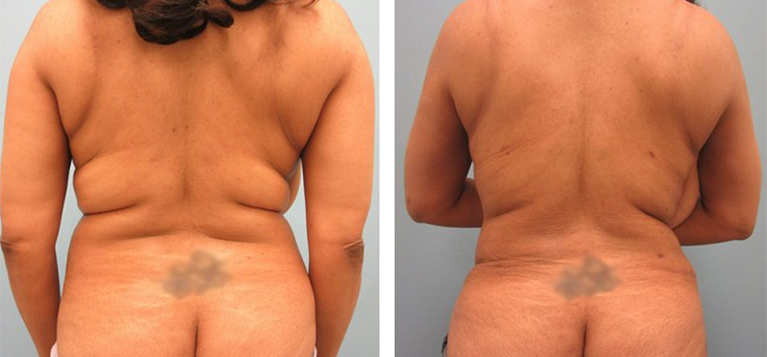 Liposuction