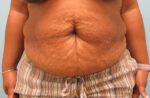 Tummy Tuck