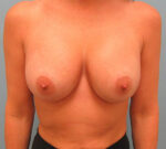 Breast Augmentation