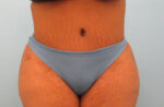 Tummy Tuck