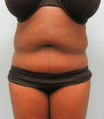 Tummy Tuck