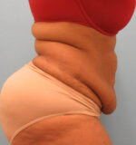 Tummy Tuck