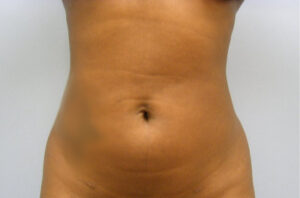 Liposuction