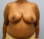 Breast Reduction