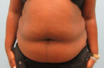 Tummy Tuck