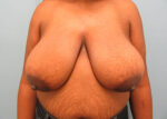 Breast Reduction