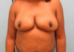 Breast Reduction