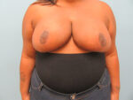 Breast Reduction