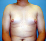 Gynecomastia