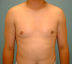 Gynecomastia