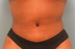 Tummy Tuck