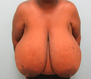 Breast Reduction