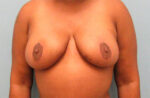 Breast Reduction