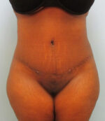 Tummy Tuck