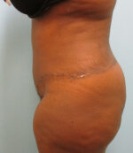 Tummy Tuck