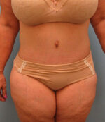 Tummy Tuck