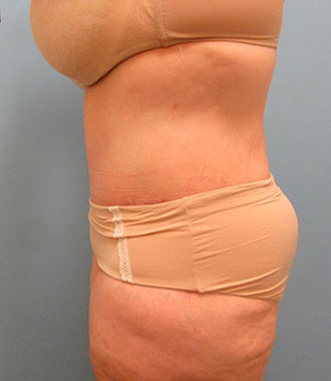 Tummy Tuck