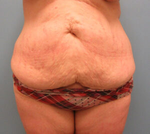 Tummy Tuck