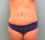 Tummy Tuck