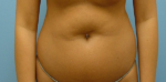 Liposuction