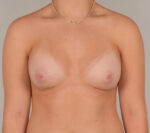 Breast Augmentation