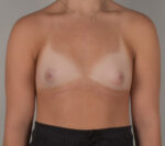 Breast Augmentation