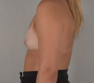 Breast Augmentation