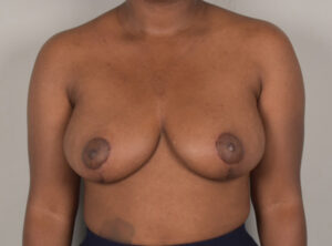 Breast Reduction
