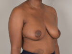 Breast Reduction