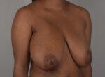 Breast Reduction