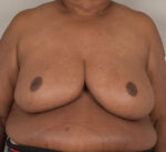 Breast Reduction