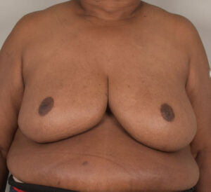 Breast Reduction