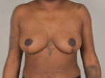 Breast Reduction