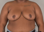 Breast Reduction