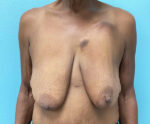 Breast Lift