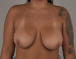 Breast Lift