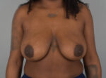 Breast Reduction