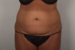 Tummy Tuck