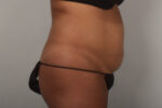 Tummy Tuck