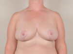 Breast Reduction