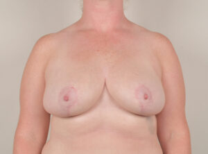 Breast Reduction