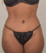 Tummy Tuck