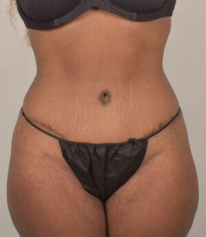 Tummy Tuck